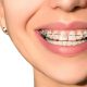 زمان ارتودنسی دندان بزرگسالان