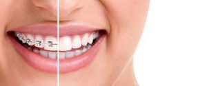 زمان ارتودنسی دندان بزرگسالان