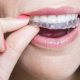 درمان کراس بایت دندان با ارتودنسی
