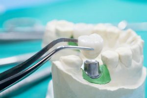 پاکسازی ایمپلنت دندان 