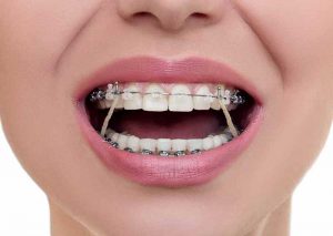 اهمیت ارتودنسی دندان