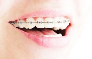 ارتودنسی دندان پرشده یا ایمپلنت شده