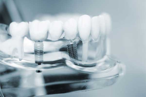علل ایمپلنت دندان