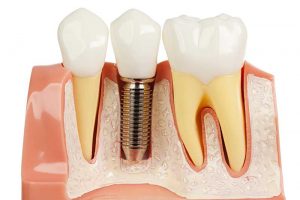 علل ایمپلنت دندان