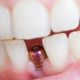 علت پس زدن ایمپلنت دندان