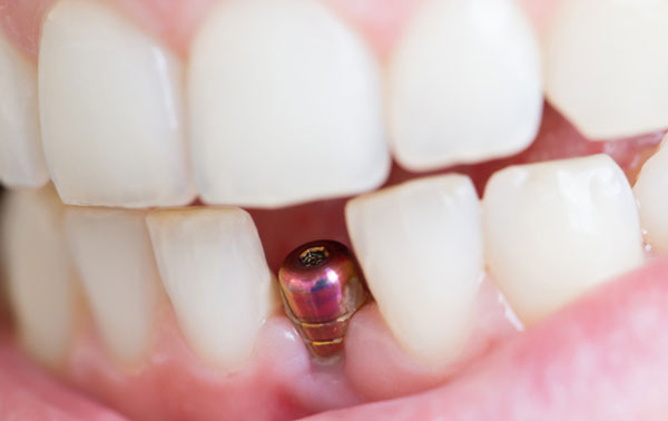 علت پس زدن ایمپلنت دندان
