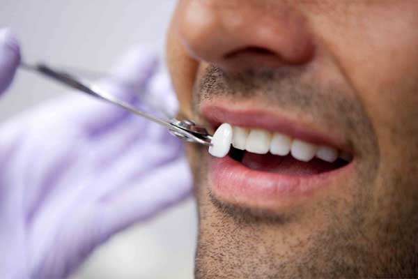 کاربرد لامینت دندان