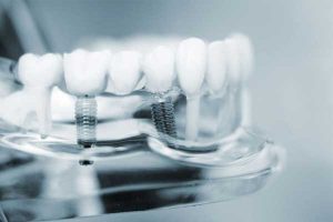 عوامل درمانی مهم در ایمپلنت دندان