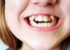 اوربایت دندان کودکان
