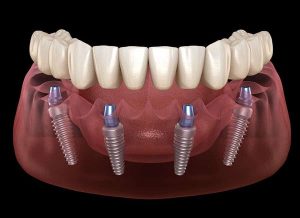 روش دوم ایمپلنت کردن دندان : All-on-4