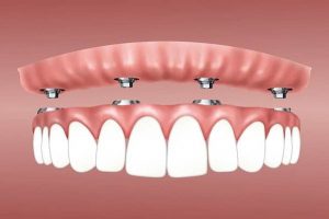 روش های ایمپلنت کردن دندان :Implant dentures