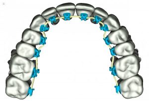 ارتودنسی دندان دیجیتالی