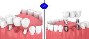 روش سوم ایمپلنت کردن دندان : ایمپلنت بریج