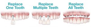 جایگزین کردن ایمپلنت های دندان