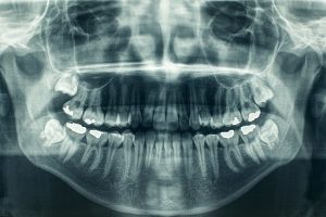 سه دلیل برای رادیولوژی دندان ها توسط دندانپزشک