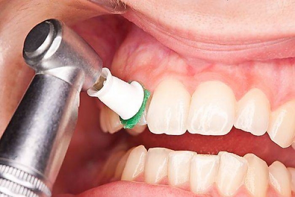 مراقبت های پس از جرم گیری دندان | کلینیک دندانپزشکی خوب غرب تهران|درمانگاه دندانپزشکی|متخصص ارتودنسی|متخصص ایمپلنت